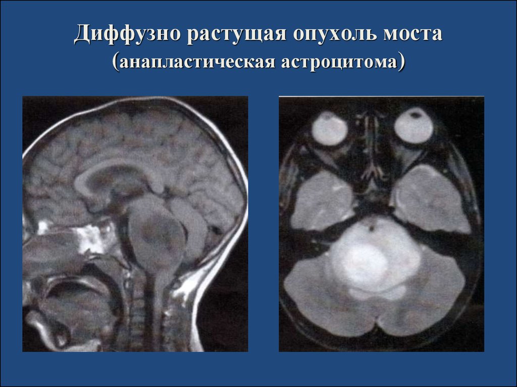 Диффузная головного мозга. Диффузная глиома ствола головного. Астроцитома ствола мозга мрт. Глиома ствола головного мозга.