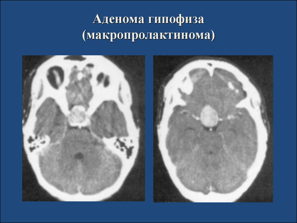 Микроаденома гипофиза. Макро аденома гипофиза кт. Аденома гипофиза кт картина. Макропролактинома в гипофизе. Множественные микроаденомы гипофиза.