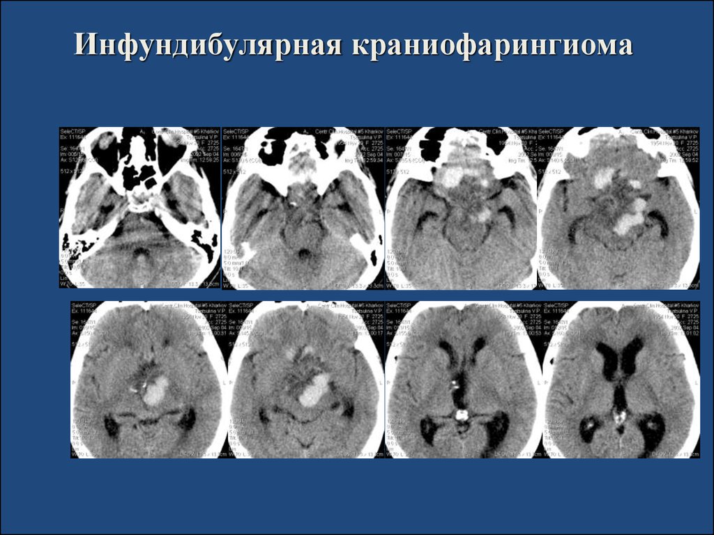 Опухоль головного мозга презентация