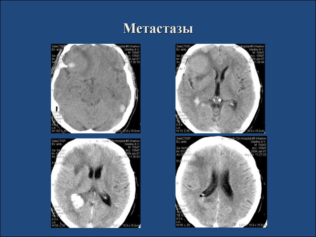 Как выглядят метастазы в головном мозге фото