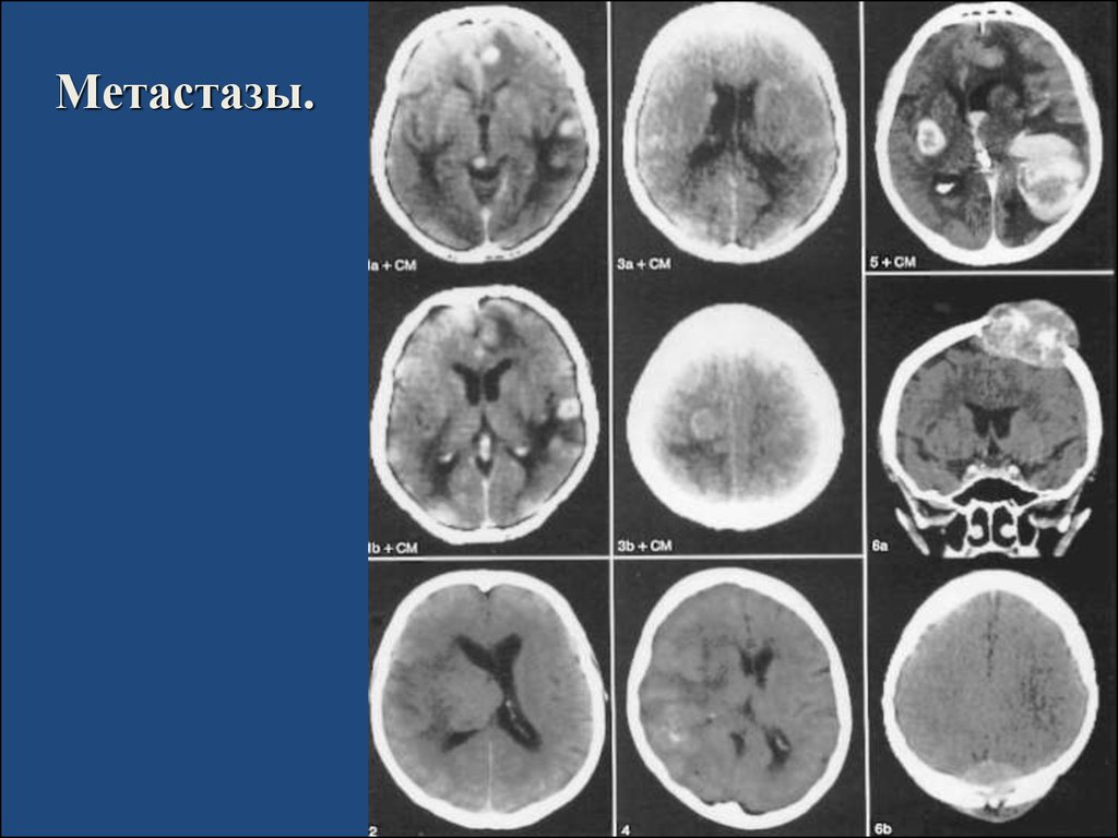 Метастазы в мозг прогноз