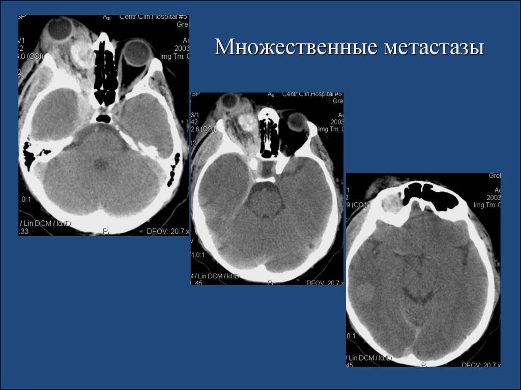 Метастазы это. Множественные метастазы. Множественные метастазы без опухоли. Единичные отдаленные метастазы. Метастаз это презентация.