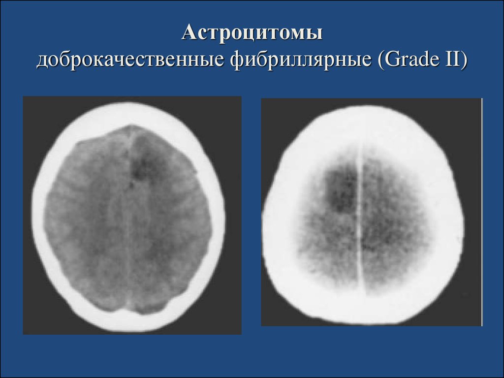 Астроцитома грейд. Фибриллярная астроцитома гистология. Протоплазматическая астроцитома. Протоплазматическая астроцитома гистология. Фибриллярная астроцитома патанатомия.