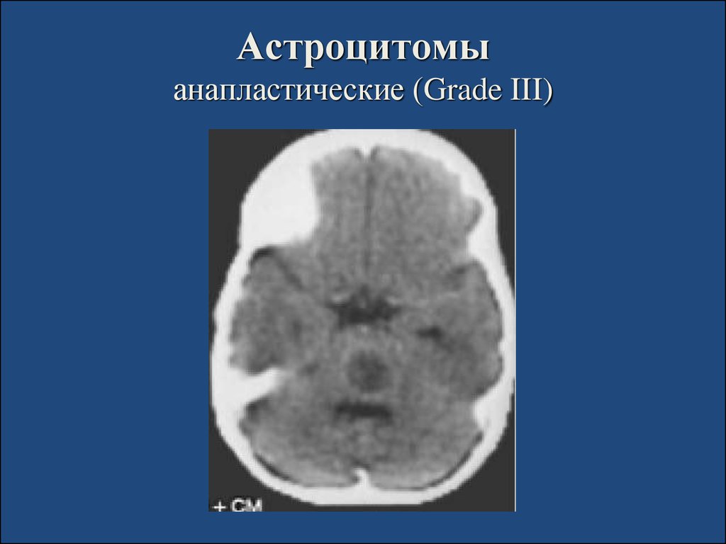 Астроцитома головного мозга прогноз. Анапластическая астроцитома Grade 3 головного мозга. Анапластическая астроцитома мозжечка кт. Анапластическая злокачественная астроцитома гистология. Анапластическая астроцитома мрт.