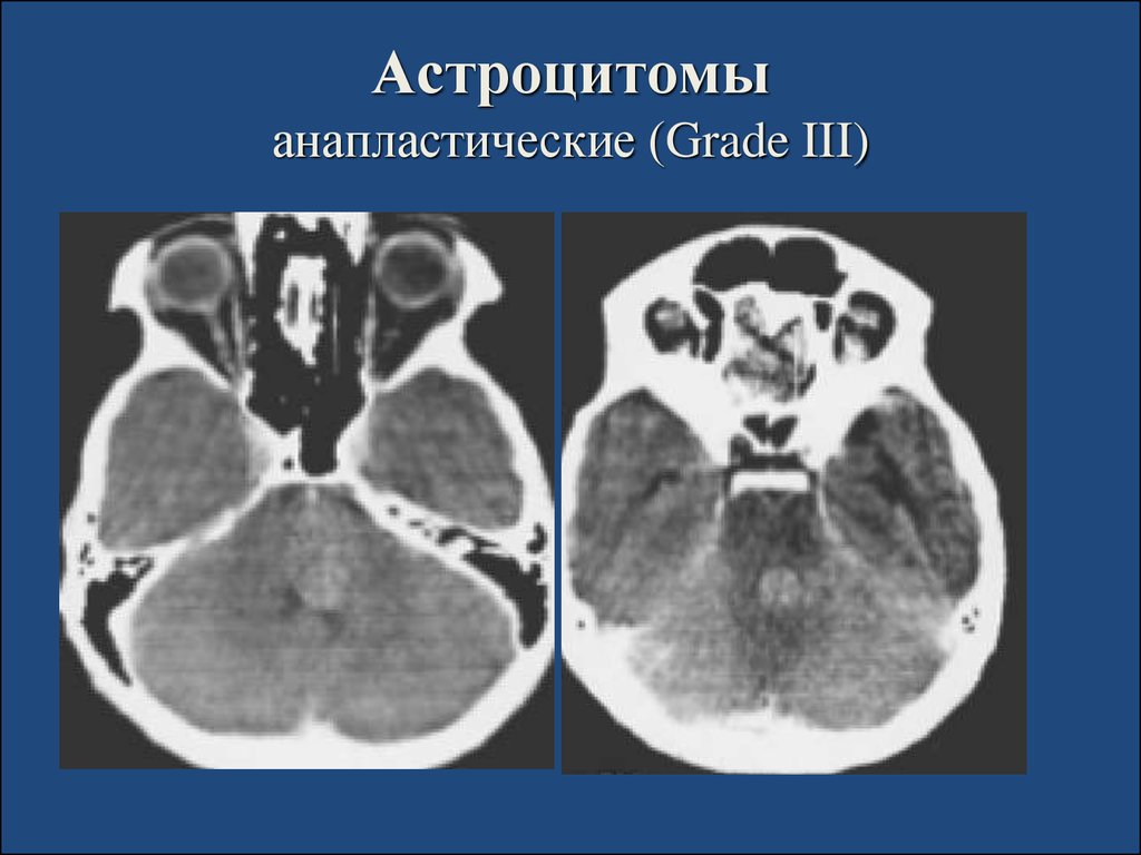 Астроцитома грейд. Астроцитома мозжечка кт. Пилоцитарная астроцитома. Пилоидная астроцитома мозжечка. Пилоцитарная астроцитома гистология.