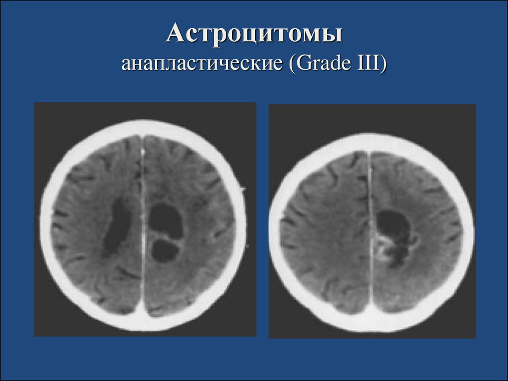 Астроцитома головного мозга прогноз. Мультифокальная астроцитома. Диффузная астроцитома мрт. Анапластическая астроцитома g3.