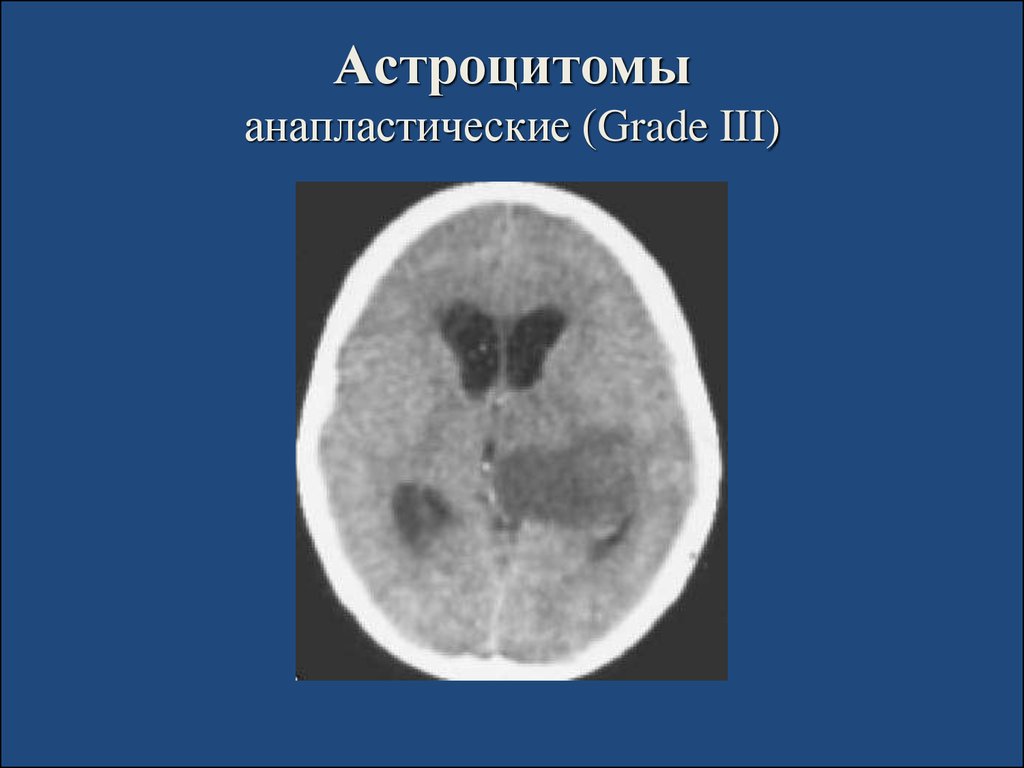 Астроцитома грейд. Астроцитома головного мозга кт. Анапластическая астроцитома g3 что это. Анапластическая астроцитома ствола головного мозга. Анапластическая астроцитома Grade 3 хиазмы.