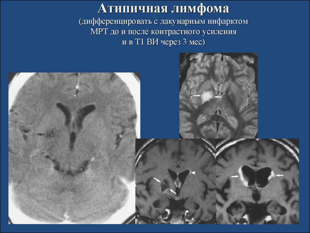 После контраста. Лакунарный инфаркт кт. Лакунарный инфаркт мозга кт. Лакунарный инфаркт мозга мрт.