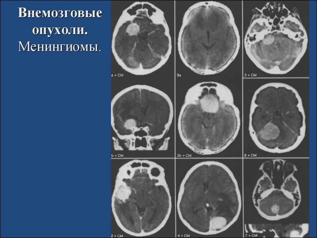 Объемное образование. Конвекситальная менингиома правой лобной области. Внемозговые опухоли головного мозга это. Внемозговые объемные образования.