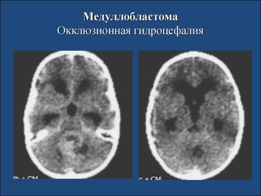 Гидроцефалия головного мозга презентация