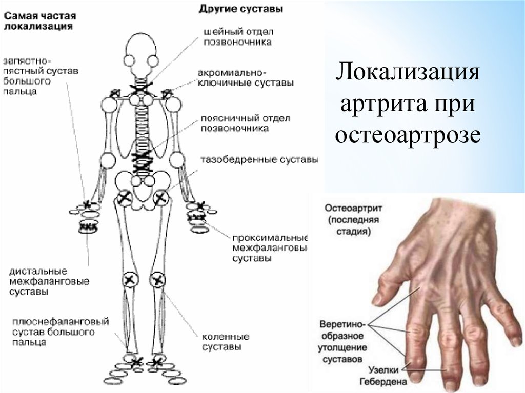 Названия суставов человека. Схема поражения суставов при ревматоидном артрите. Схема суставов ревматоидный артрит. Название всех суставов человека. Локализация остеоартроза.