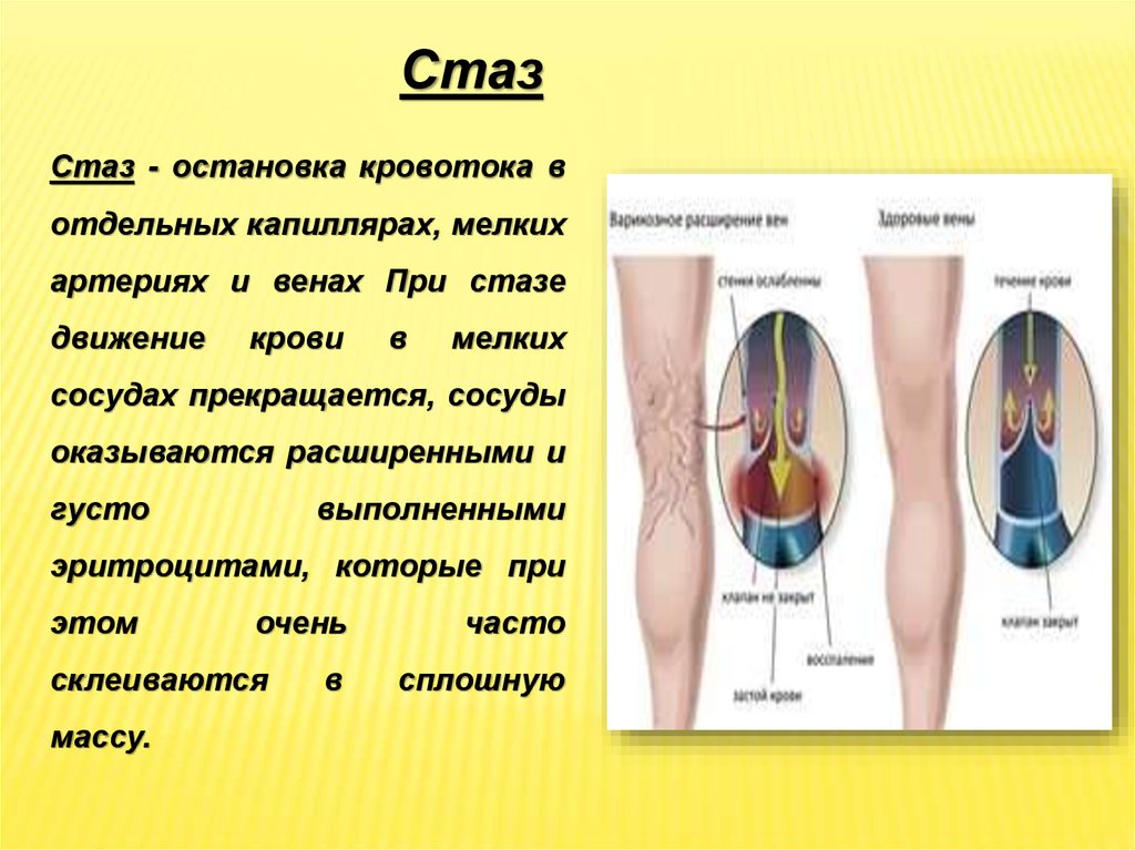 Стаз это. Истинный капиллярный стаз. Стаз остановка тока крови. Стаз местная остановка кровотока в мелких.