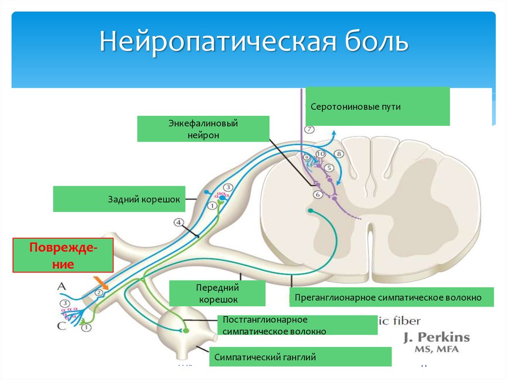 Нейропатическая боль что. Нейропатическая боль. Ноцицептивная и нейропатическая боль. Механизм ноцицептивной и нейропатической боли. Нейропатическая и Ноцицептивная боль терапевтическая тактика.