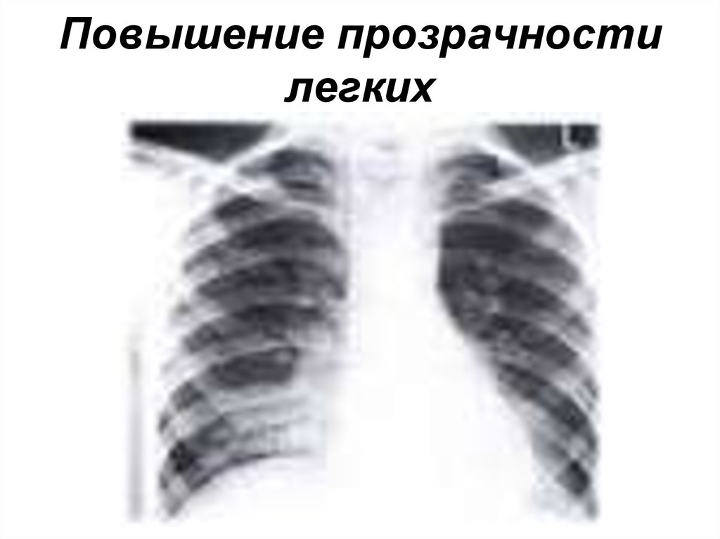 Прозрачное легкое. Повышение прозрачности легочных полей. Повышение прозрачности легких. Повышение прозрачности легких на рентгенограмме. Повышение прозрачности легочной ткани.