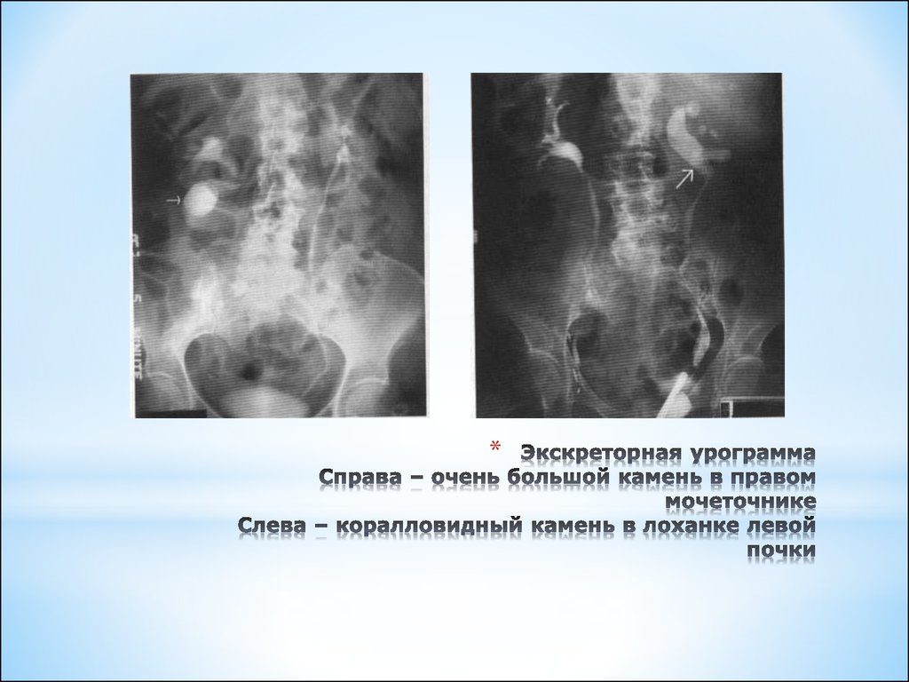 Конкременты лоханки. Коралловидный камень рентген. Туберкулез почек рентгенодиагностика. Камень лоханки правой почки.