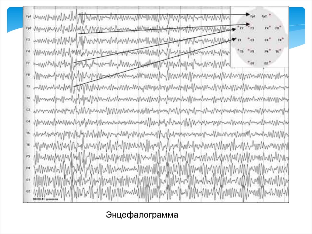 Энцефалограмма воронеж
