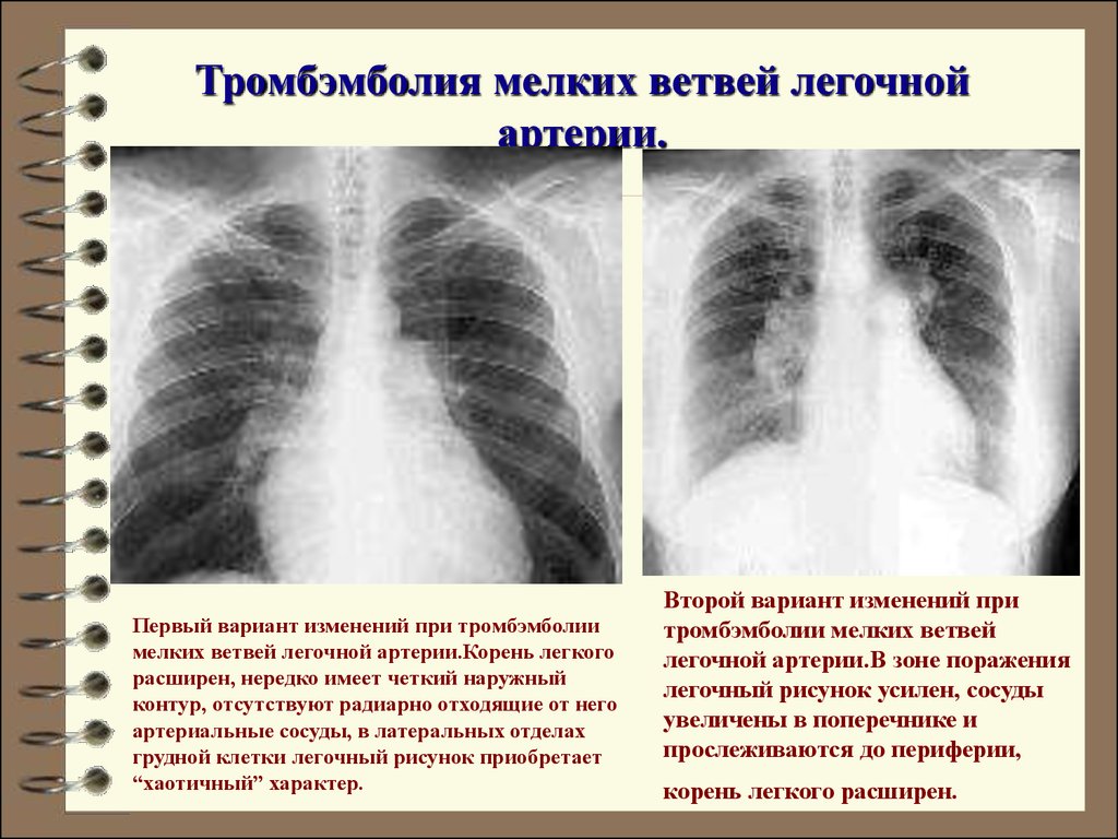 Корни легких усилены. Расширение корня легкого на рентгене. Корни лёгких на рентгенограмме.