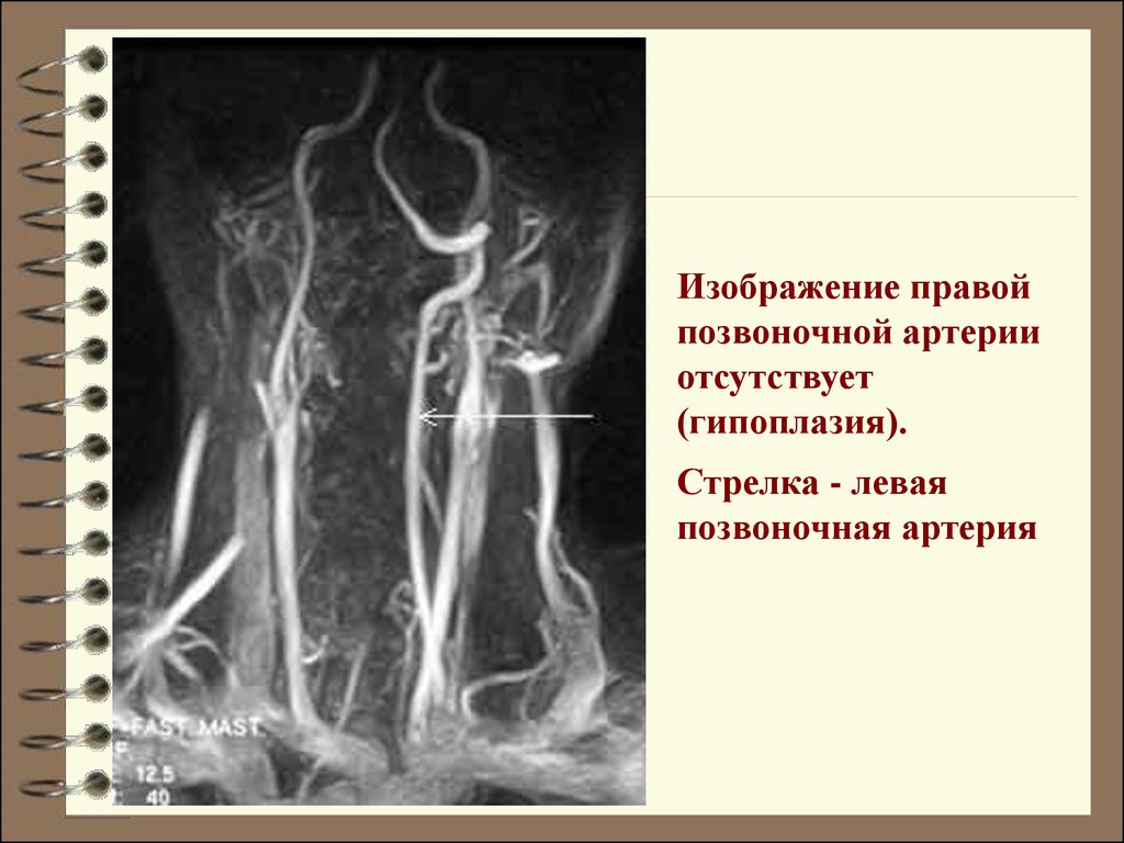 Гипоплазия сегмента v4 позвоночных артерий. МРА картина гипоплазии v4 сегмента правой позвоночной артерии что это. Гипоплазия v4 позвоночной артерии. V4 позвоночной артерии. Гипоплазия отдела правой позвоночной артерии.