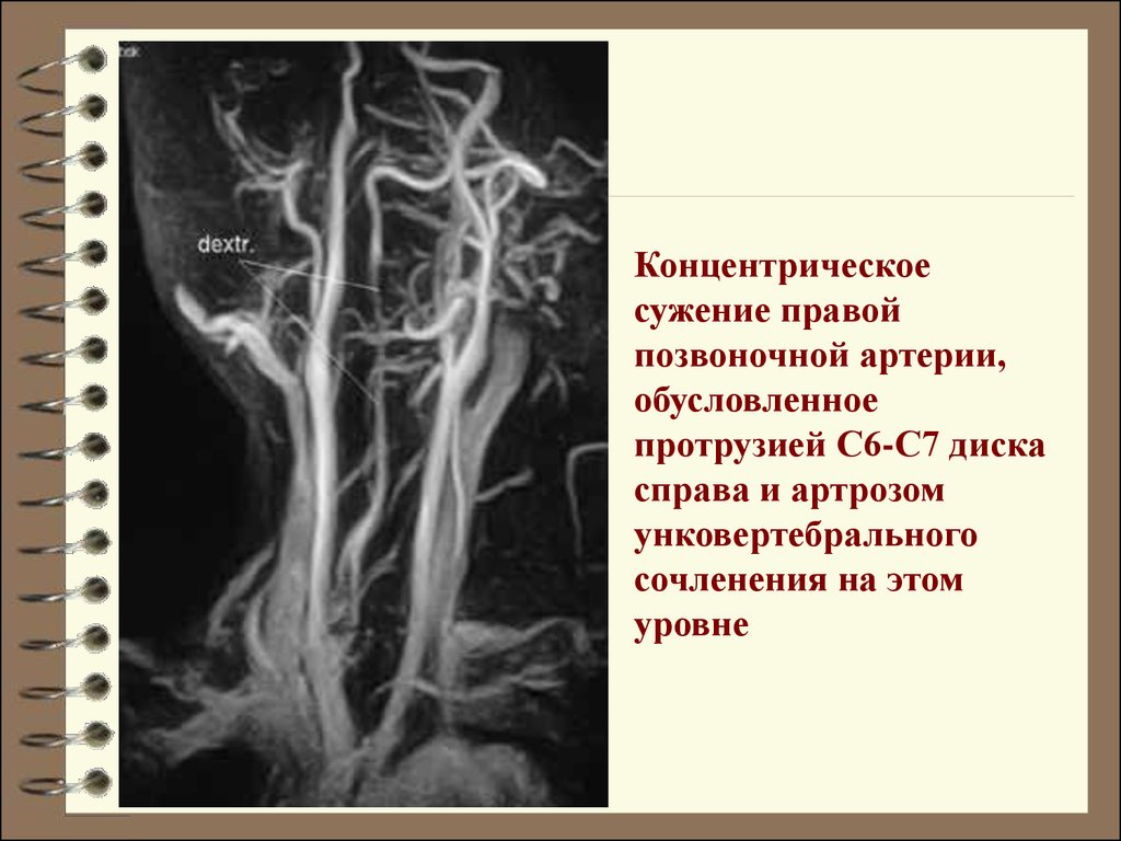 Сужение правой артерии. Гипоплазия позвоночной артерии мрт. Сужение правой позвоночной артерии. Стеноз правой позвоночной артерии. Сужение просвета правой позвоночной артерии.