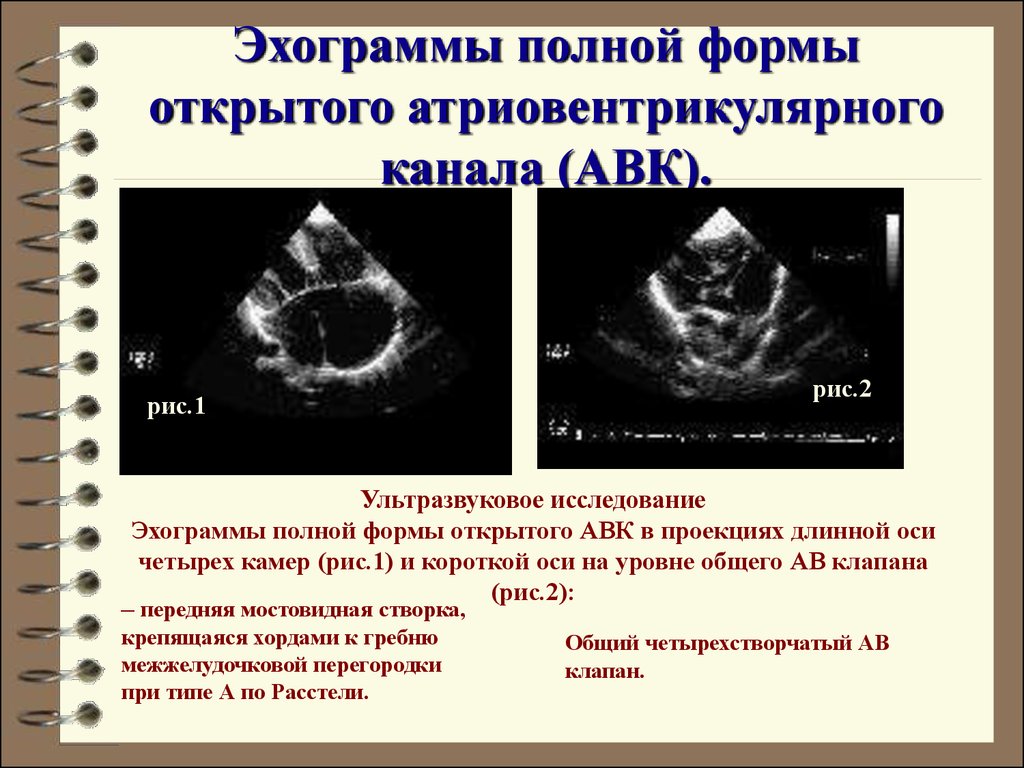 Узи полное. Частично- открытый атриовентрикулярный канал ЭХОКГ. Неполная форма АВК ЭХОКГ. Атриовентрикулярная коммуникация ЭХОКГ. Общий открытый атриовентрикулярный канал.