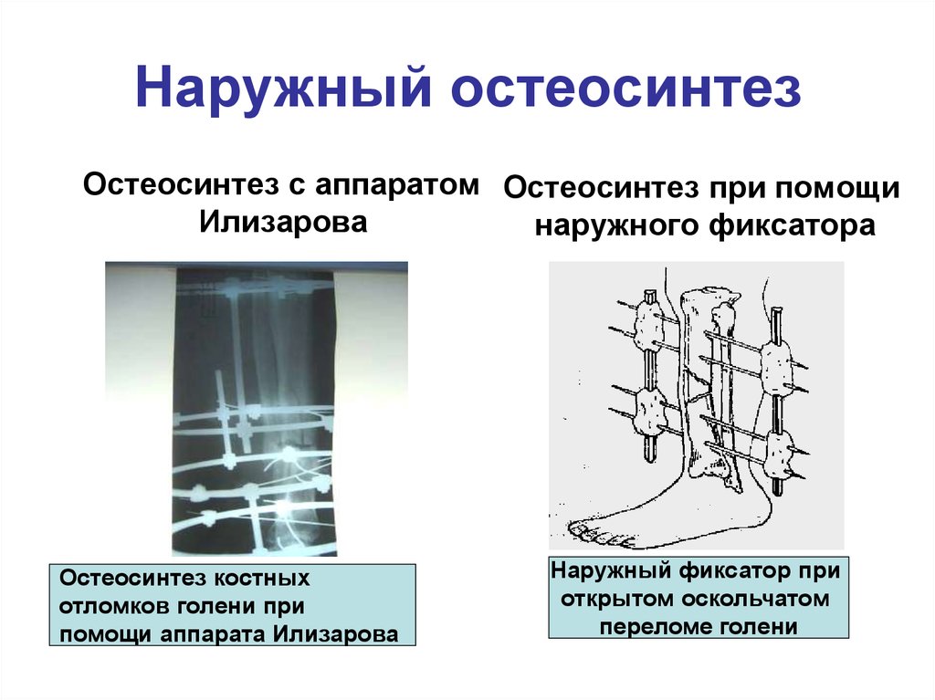 Внеочаговый остеосинтез презентация