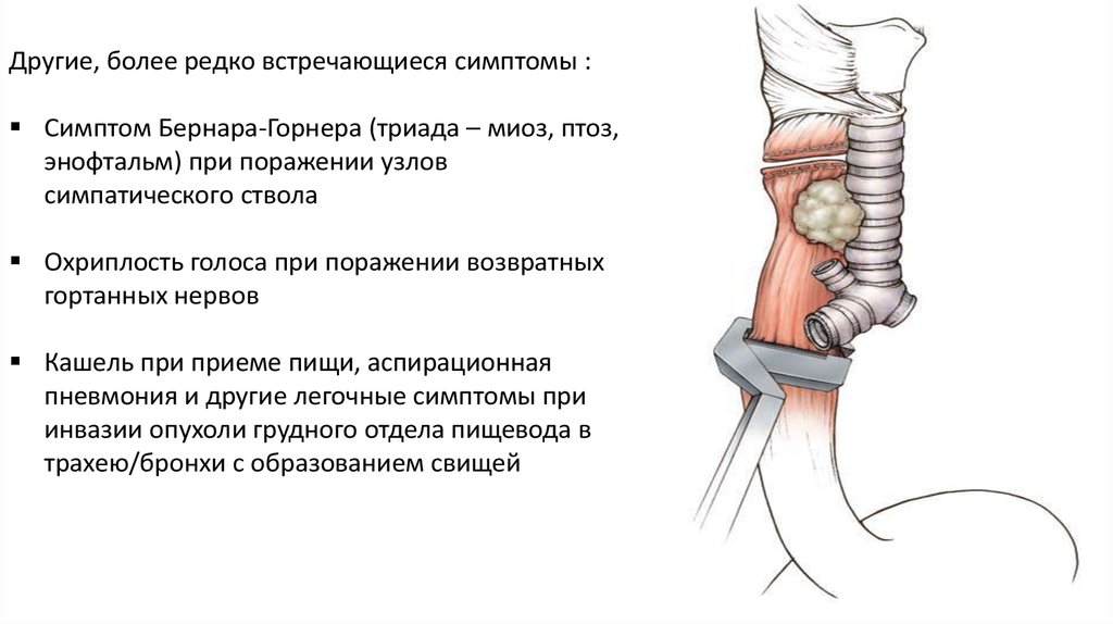 Зно пищевода карта вызова