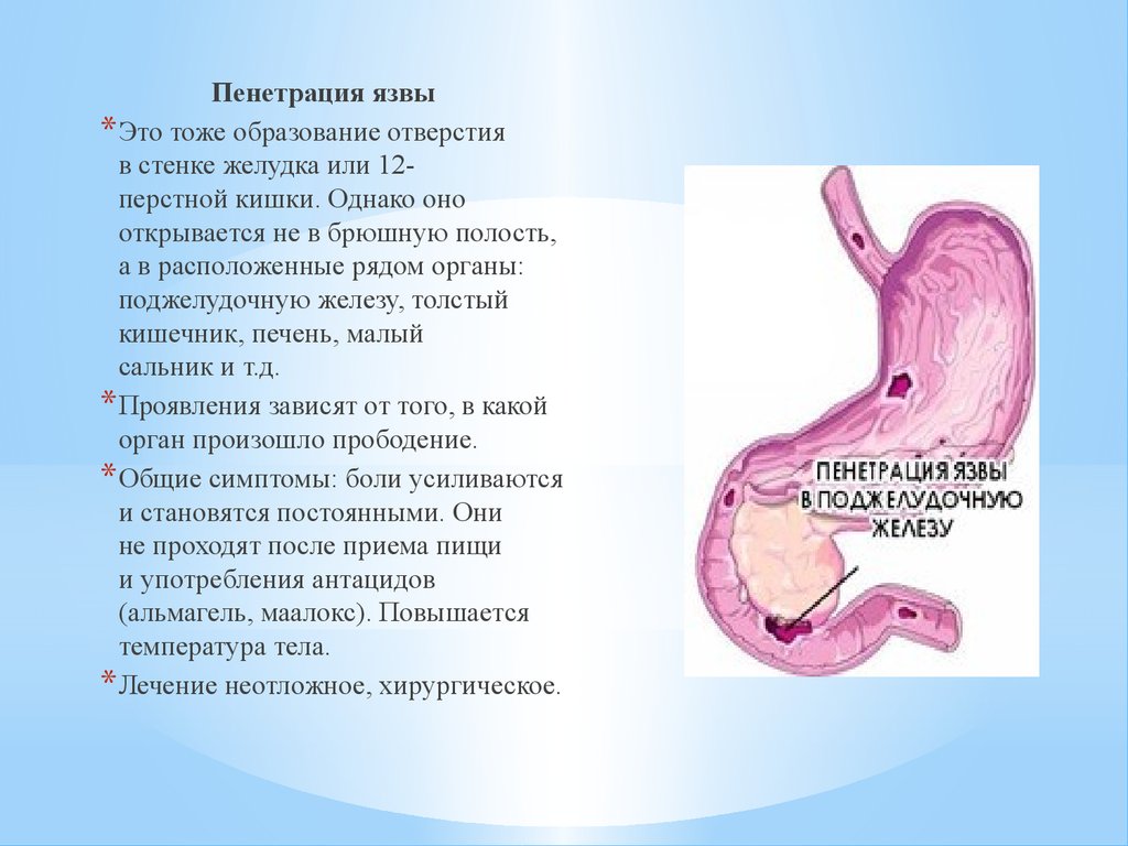 Осложнения желудка 12 перстной кишки. Пенетрация язвы 12 перстной кишки. Пенетрация язвенной болезни желудка. * Пенетрация язвы 12-перстной поджелудочную железу. Язвенная болезнь желудка ДПК осложненная.