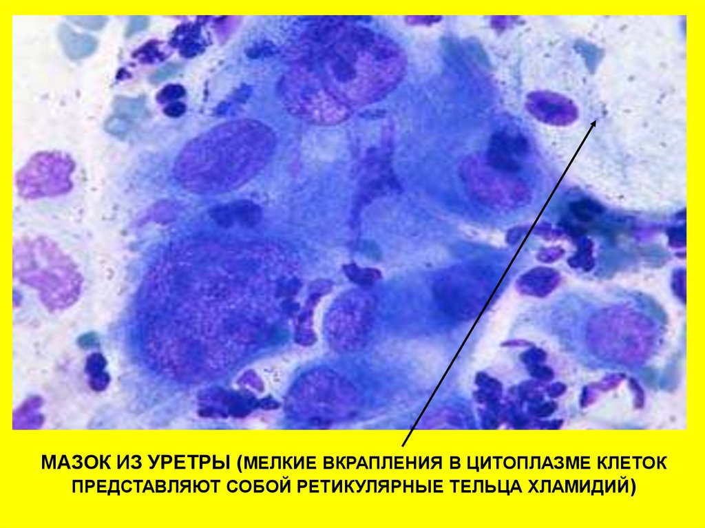 Соскоб хламидия. Хламидиоз микроскопия мазка. Трихомонады цитология. Урогенитальный хламидиоз микроскопия.