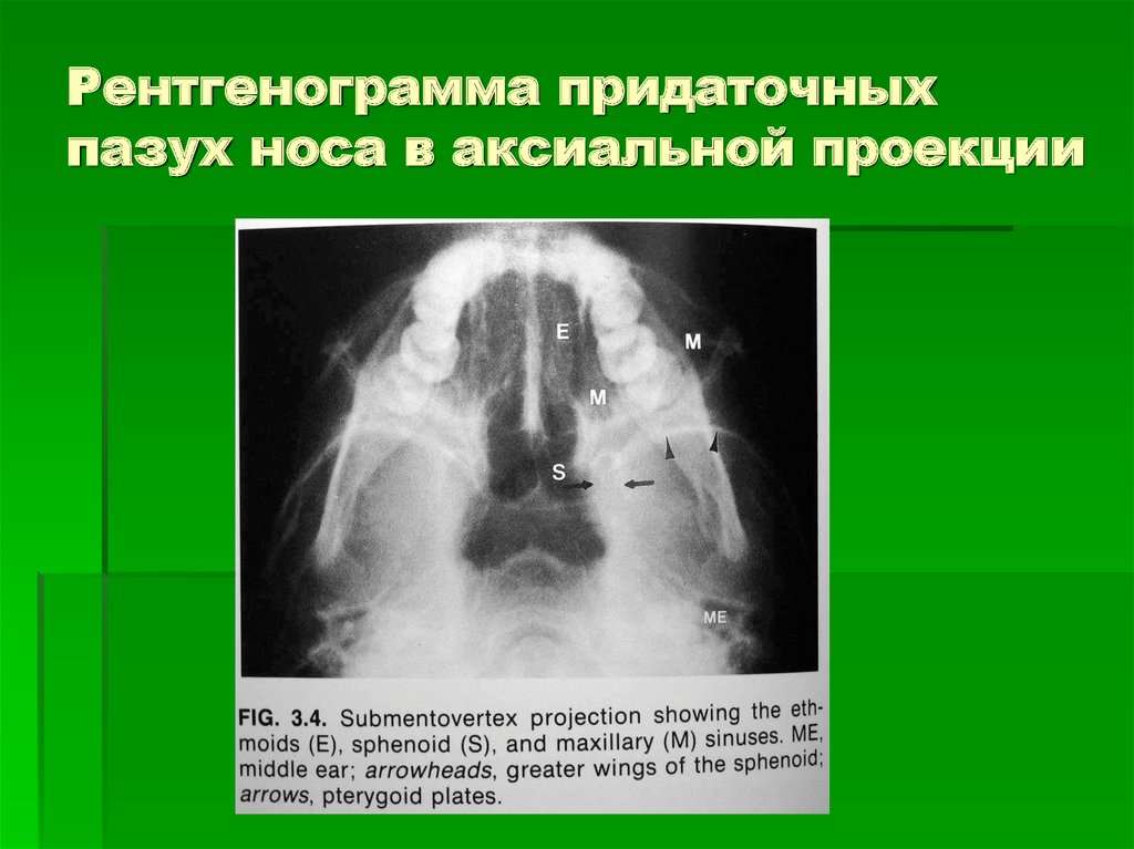 Заболевания придаточных пазух носа. Аксиальная проекция придаточных пазух носа. Рентгенография околоносовых пазух проекции. Рентгенография придаточных пазух носа (2 проекции). Рентген околоносовых пазух в 2 проекциях.