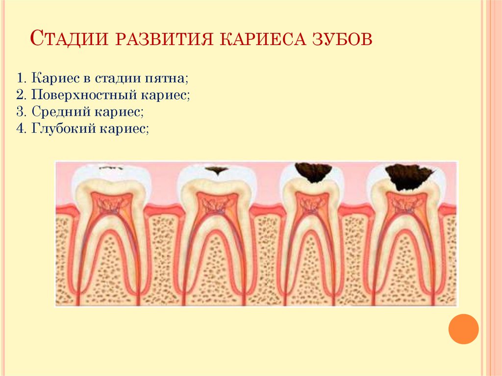 Виды кариеса зубов фото