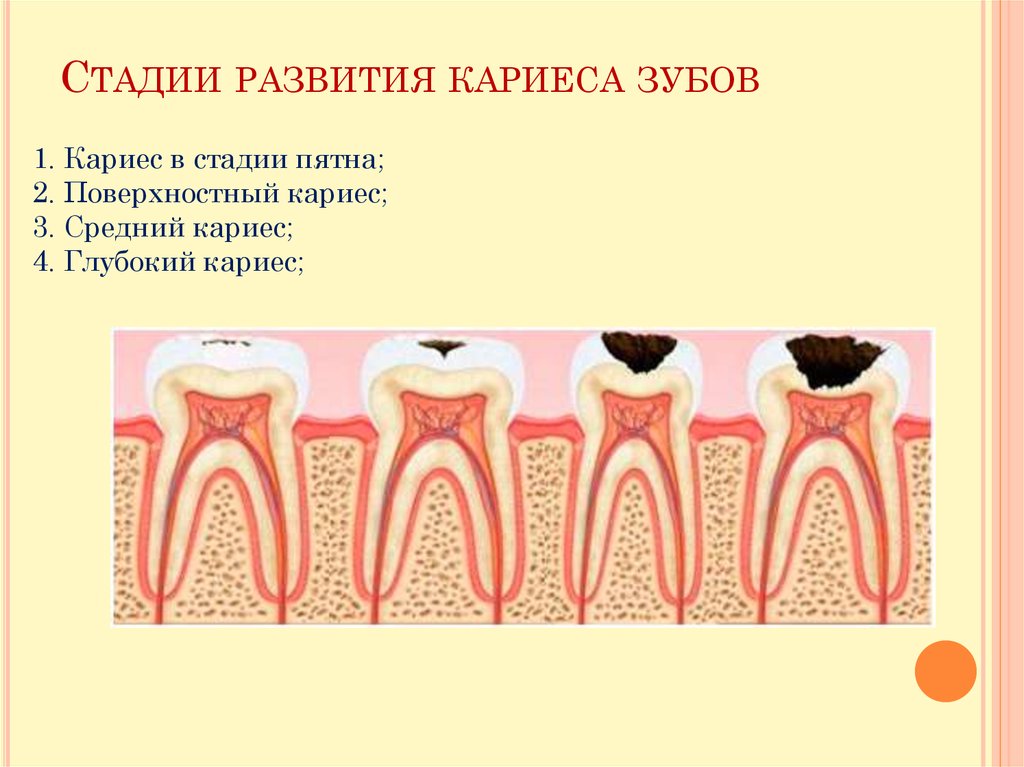 Клиническая картина кариеса