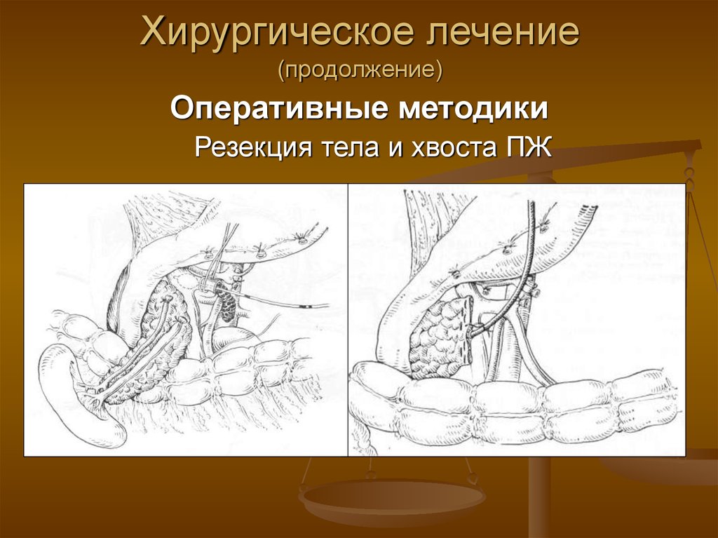 Хирургическое лечение хронического панкреатита. Хирургическое лечение острого панкреатита. Острый панкреатит операция. Методы дренирующих операций при остром панкреатите.