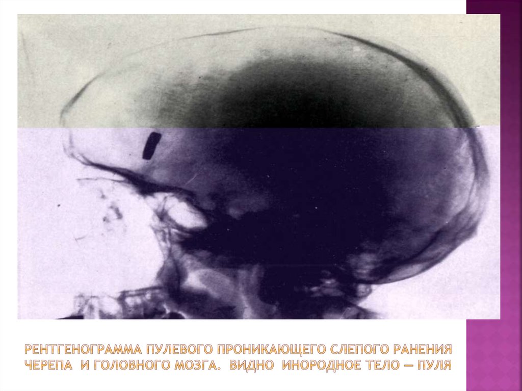 Рентгенограмма пулевого проникающего слепого ранения черепа и головного мозга. Видно инородное тело — пуля