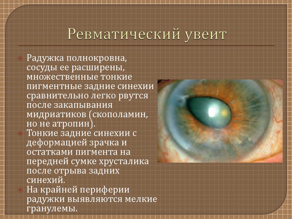 Заболеваниями заболеваний глаз появиться. Увеит (воспаление сосудистой оболочки глаза).. Ревматоидный иридоциклит кератит,.