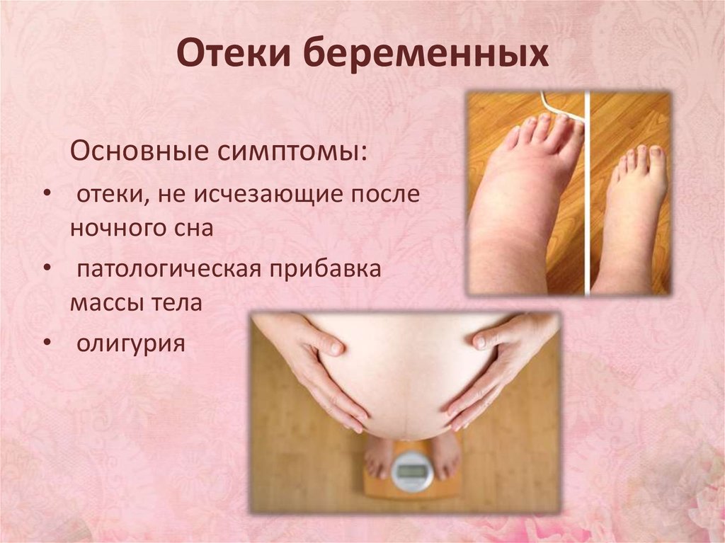 Уменьшение отечности. Отеки беременных симптомы. Отеки вызванные беременностью.