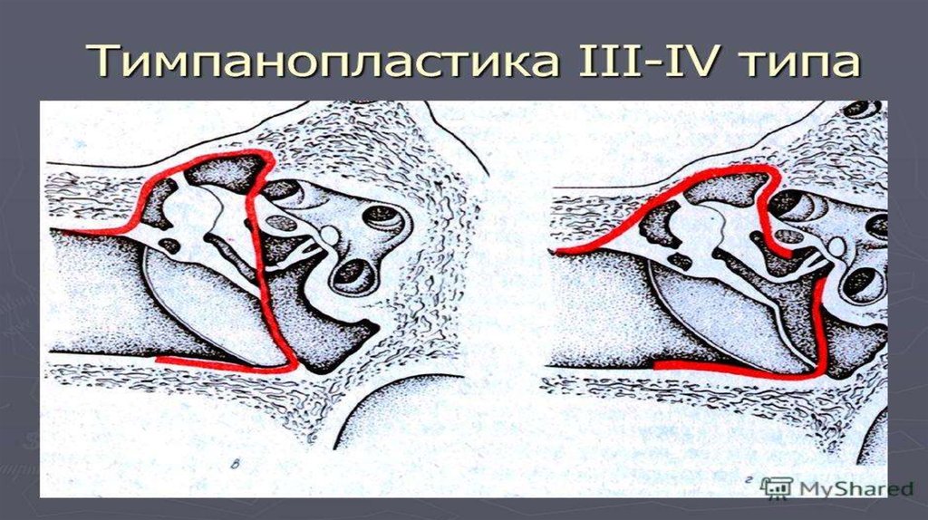 Заболевания среднего уха. Адгезивная болезнь среднего уха.