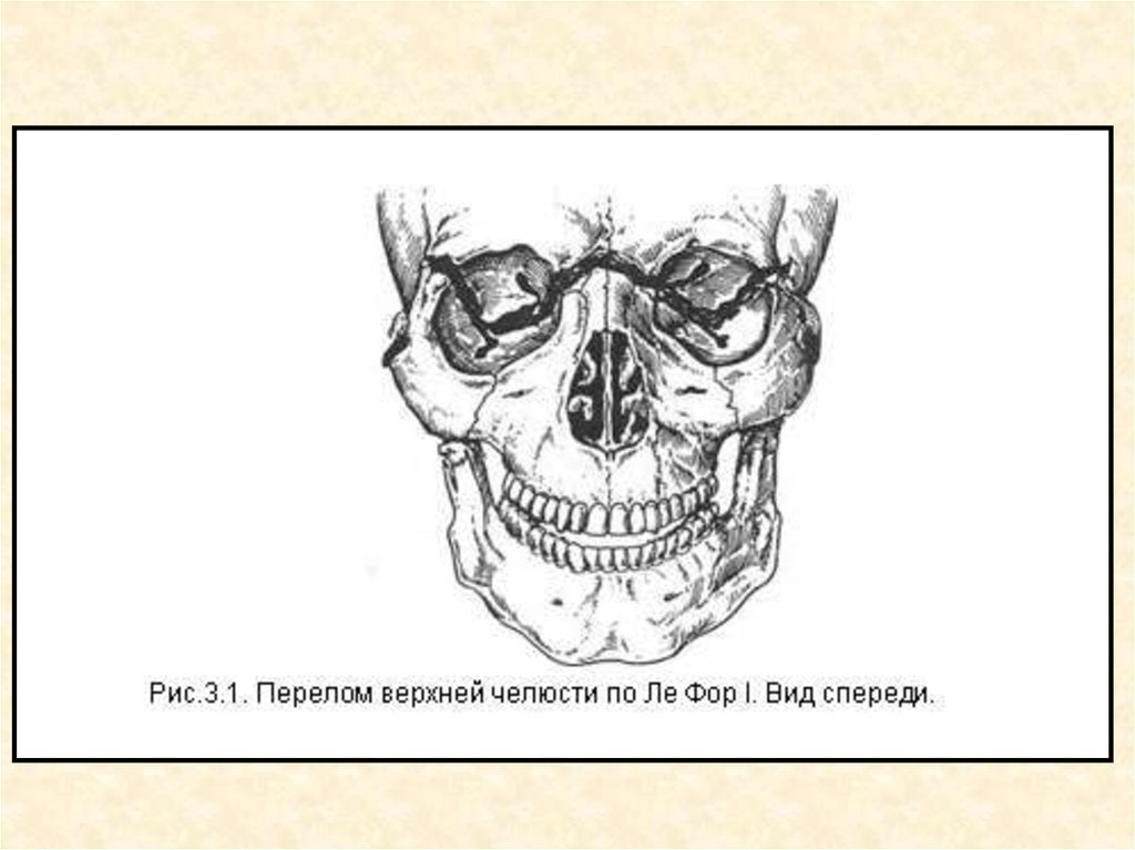 Переломы костей верхней челюсти. Лефор классификация переломов верхней челюсти. Перелом нижней челюсти по Лефору. Суббазальный перелом верхней челюсти.