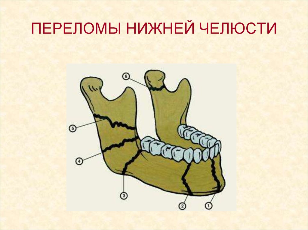 Закрытый перелом нижней челюсти карта вызова локальный статус