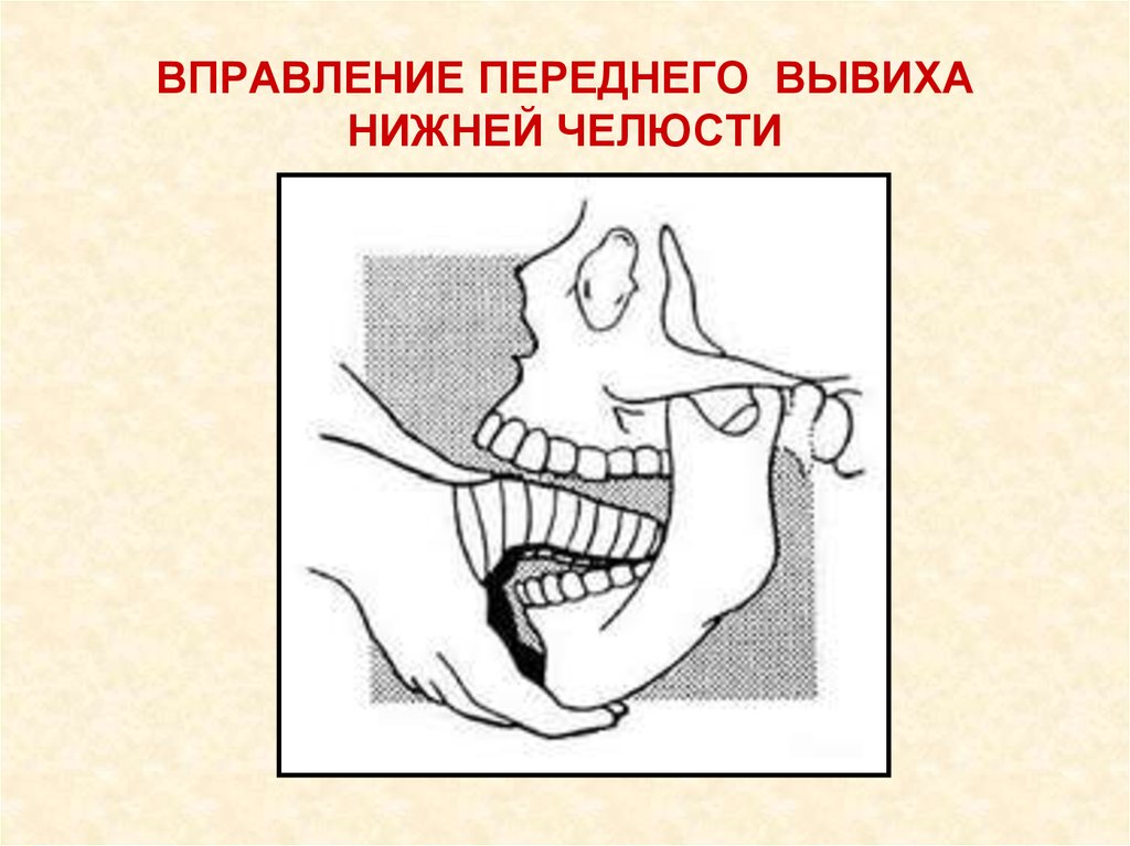 Вывих челюсти. Вправление вывиха челюсти. Метод вправления вывиха нижней челюсти. Методика вправления вывиха нижней челюсти.