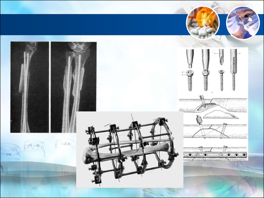 Этапы лечения переломов. Принципы остеосинтеза АО. Принципы лечения переломов костей. Остеосинтез предплечья пластинами.