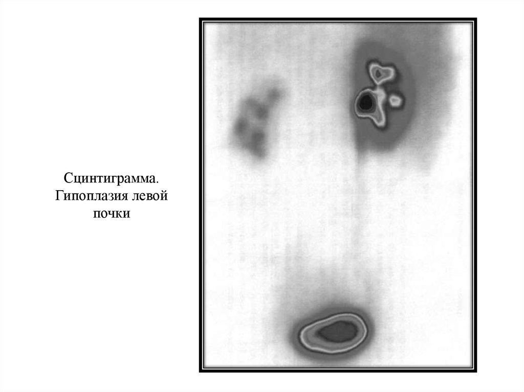 Гипоплазия левой. Гипоплазия почки сцинтиграмма. Гипоплазия левой почки. Сцинтиграмма гипоплазия левой почки. Ветрянка при гипоплазии почки.