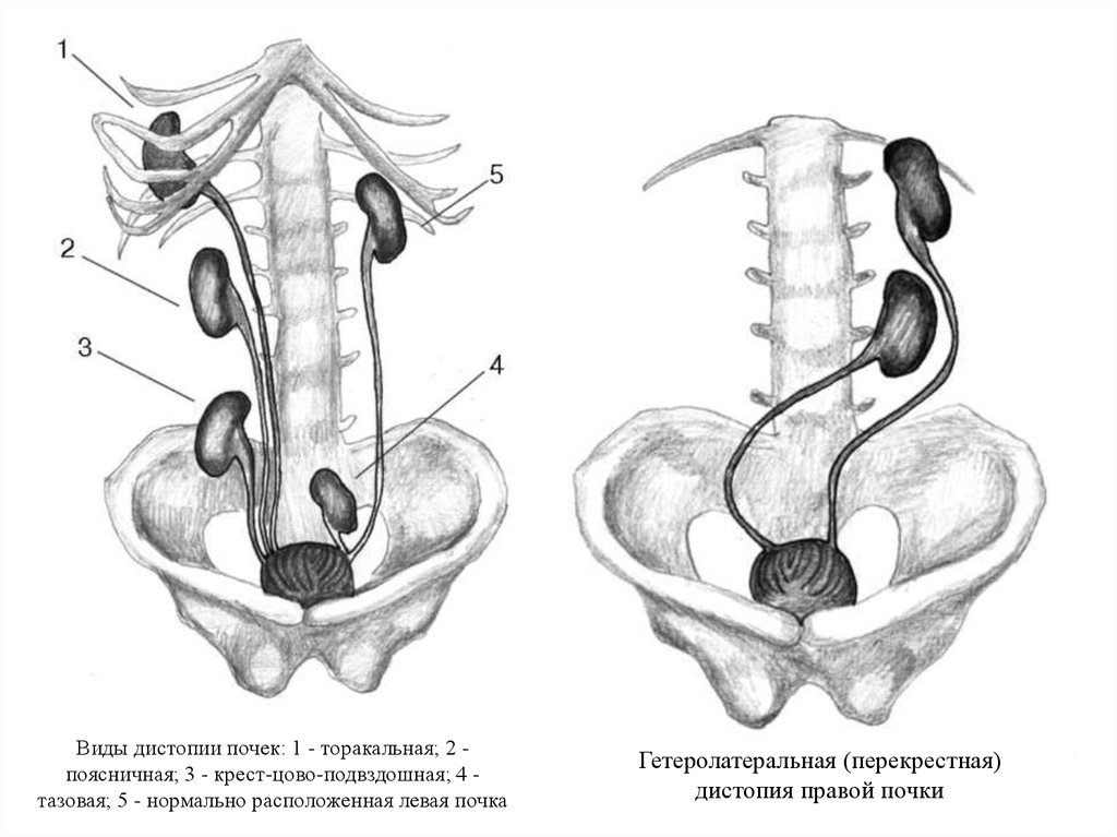 Нарушения развития почек. Подвздошная дистопия почки. Аномалии развития почек дистопия. Гомолатеральная дистопия почки. Дистопия (эктопия) почек.