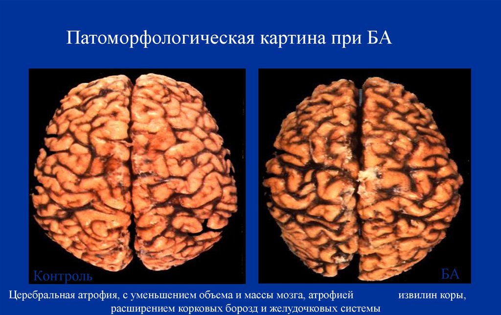 Умеренная атрофия мозга. Атрофия коры головного мозга. Диффузная атрофия мозга. Церебральная атрофия 1.