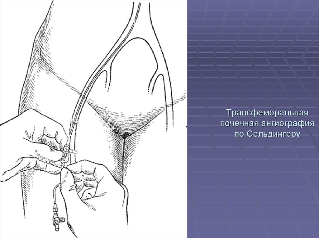 Схема по сельдингеру рентген