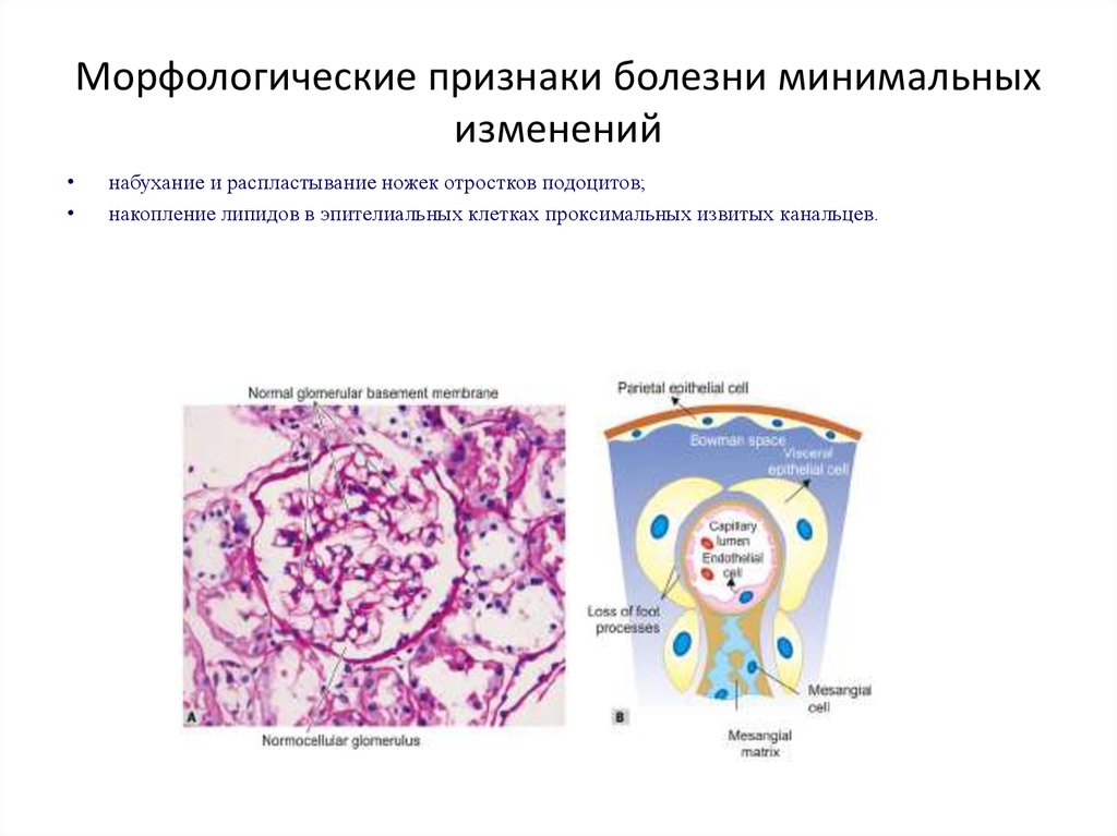 Заболевания морфологические признаки. Болезнь минимальных изменений гломерулонефрит. Болезнь минимальных изменений патогенез. Морфологические признаки болезни минимальных изменений. Болезнь малых отростков подоцитов.