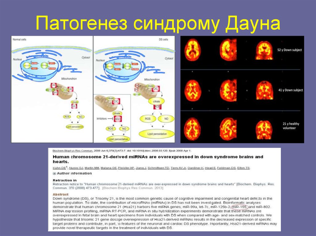 Синдром дауна схема