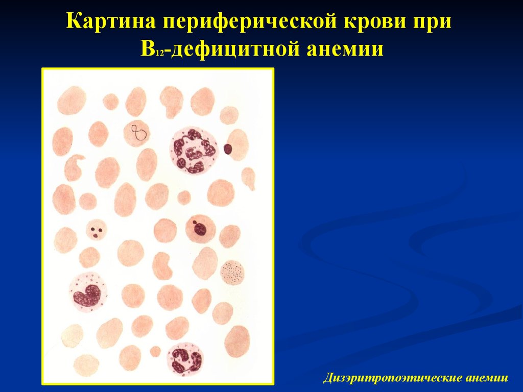 В12 при железодефицитной анемии. Картина крови при в12-фолиеводефицитной анемии. Б12 дефицитная анемия картина крови. Картина крови при в12 дефицитной.