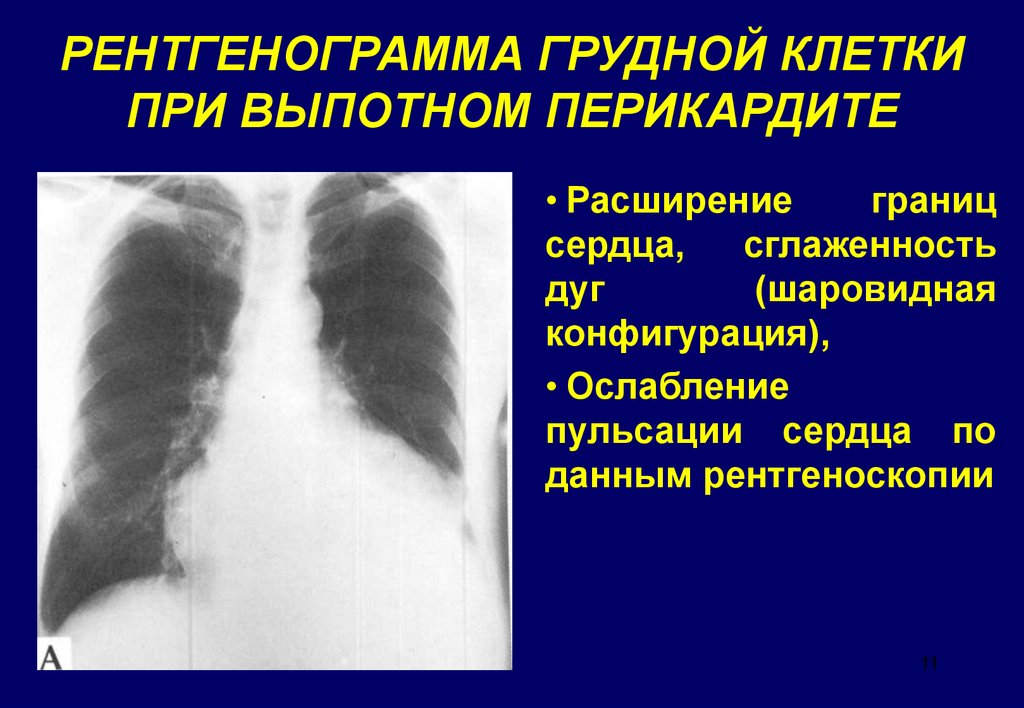 При выпотном перикардите на рентгенограмме наблюдается легочный рисунок тест ответ