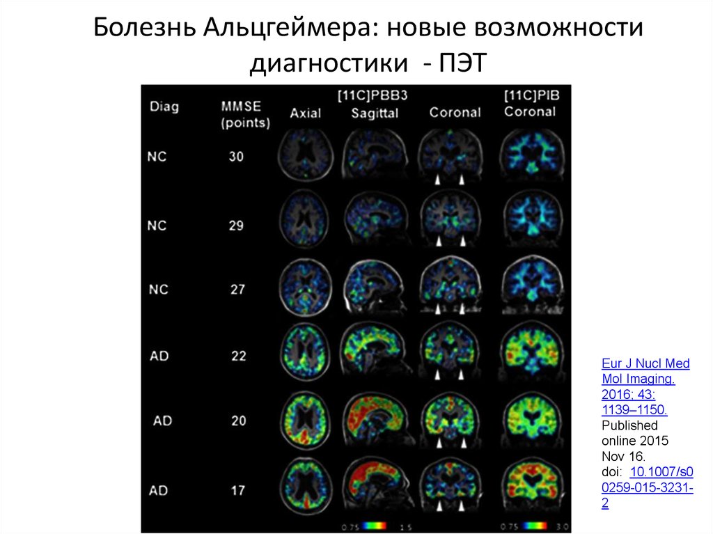 Фото на тест альцгеймера