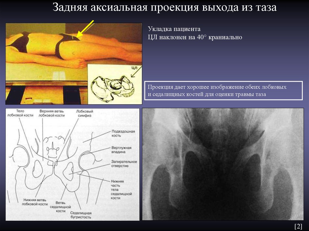 Аксиальная проекция. Рентгеноанатомия лонного сочленения. Рентген тазобедренного сустава в аксиальной проекции. Аксиальная проекция таза.